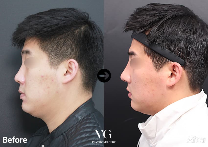 Male side profile before and after bulbous tip correction: a rounded tip becomes narrower and projects further from the face