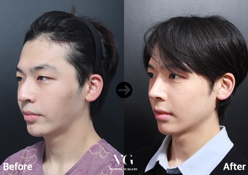 男性の斜め45度の術前術後比較。術後は頬骨の横への張り出しが減り、鼻筋が高く通って鼻先が細くなっている