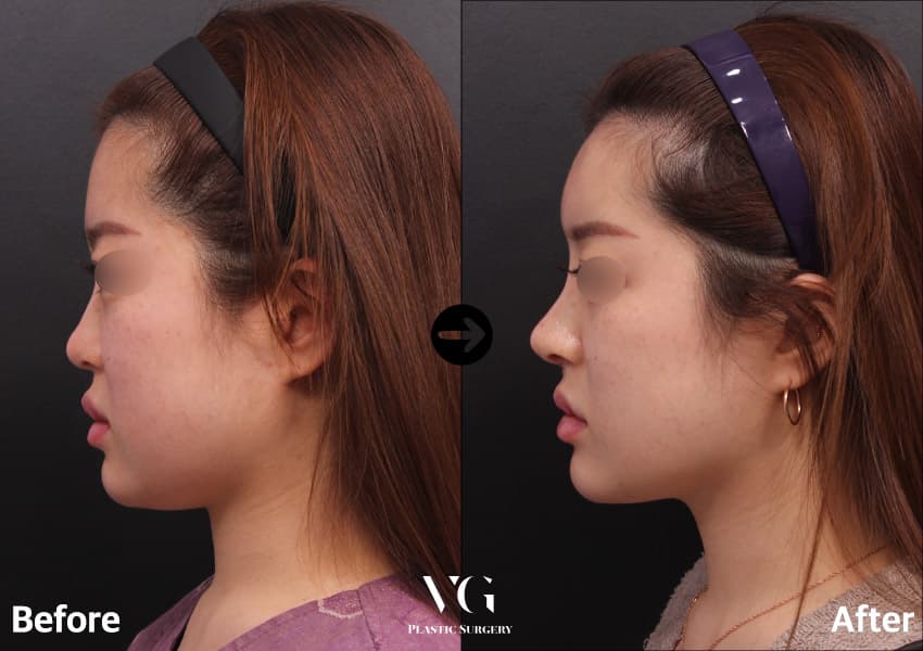 Side profile before and after short nose surgery with donor rib cartilage: the tip moves down and forward and the profile line lengthens