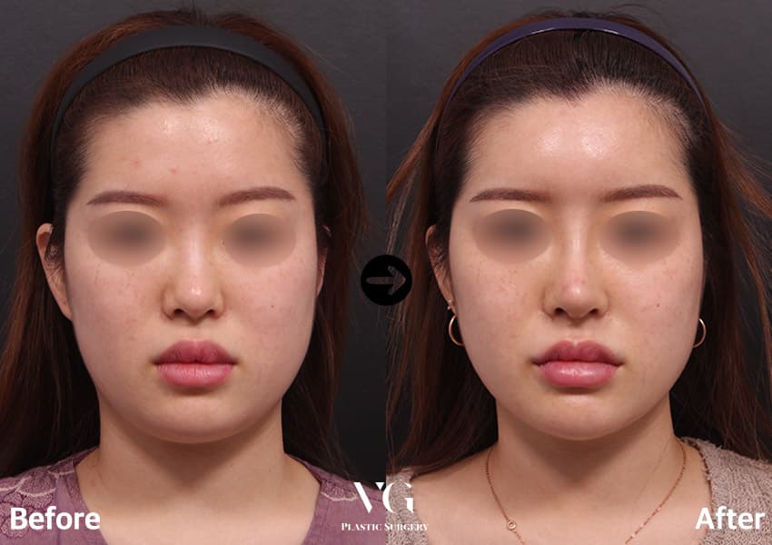 Front view before and after short nose surgery: the nostril openings are less visible and the bridge looks straighter