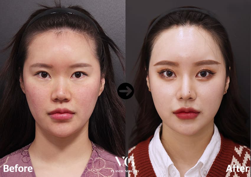 코성형 + 복코 교정 + 이마거상술 + 듀얼트임 — 각도 1
