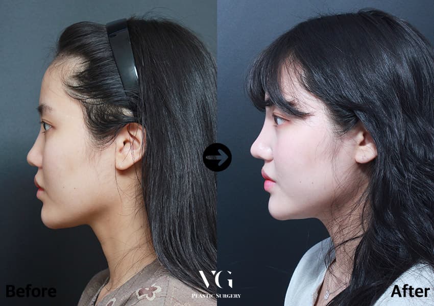 ภาพด้านข้างก่อนและหลังศัลยกรรมจมูกร่วมกับตัดกระดูก 3 เดือน สันจมูกสูงขึ้นและเส้นจมูกตรงขึ้น