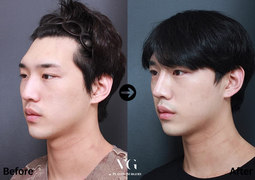 เสริมจมูก + แก้ไขจมูกเป็นสัน + ผ่าตัดกระดูกจมูกให้แคบลง