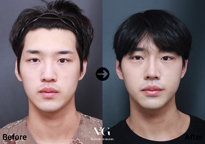 同じ男性の正面の術前術後比較。骨切り後、眉間から鼻先までの鼻筋が術前より細く、輪郭がはっきり見える