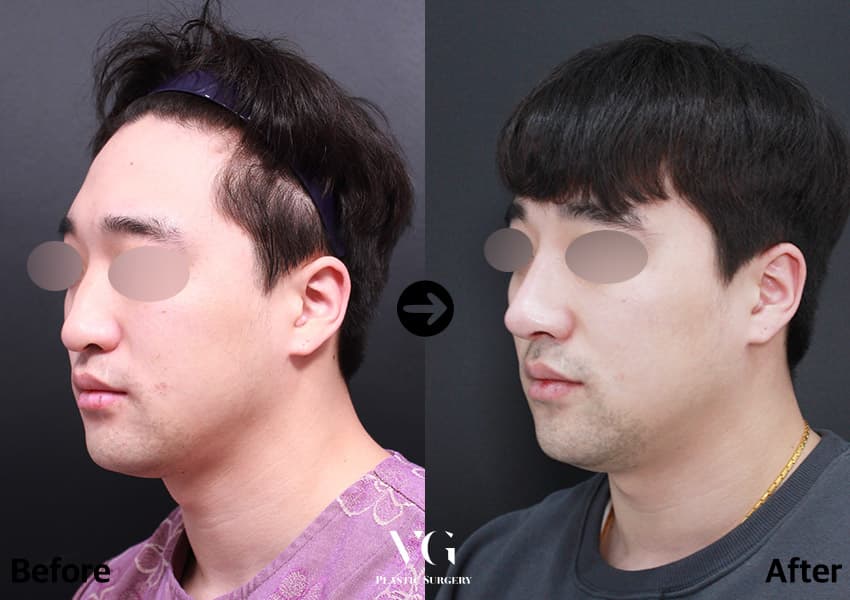 เสริมจมูก + กระดูกอ่อนซี่โครงตนเอง + แก้ไขจมูกเบี้ยว +1