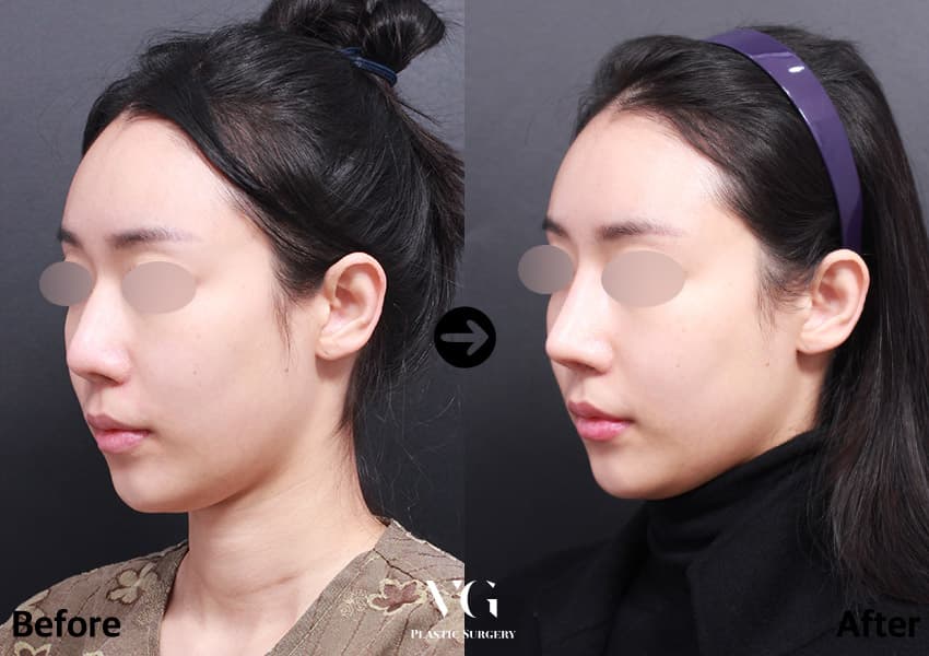 ผ่าตัดจมูกแก้ไข + กระดูกอ่อนซี่โครงบริจาค + แก้ไขจมูกเป็นสัน — มุมที่ 1