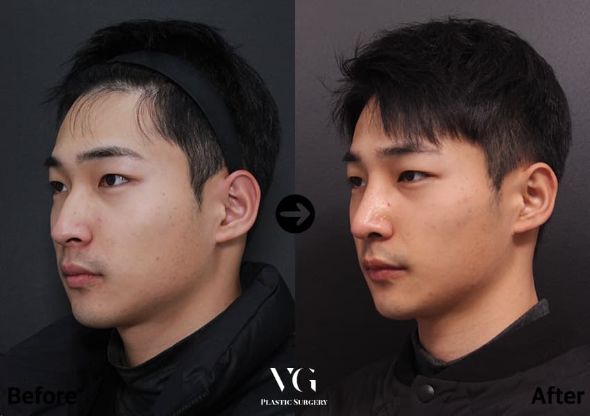 เสริมจมูก + แก้ไขจมูกเป็นสัน + ผ่าตัดกระดูกจมูกให้แคบลง +1