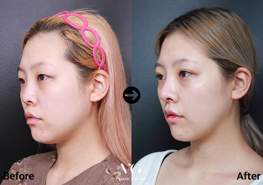 เสริมจมูก + ลดปีกจมูก + กระดูกอ่อนซี่โครงตนเอง +2