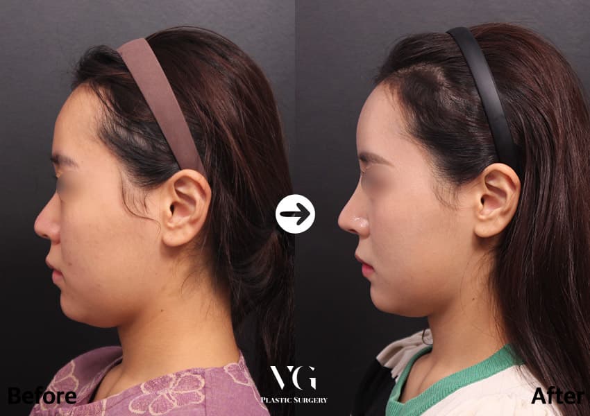 Side profile before and after bulbous tip correction: a low, rounded tip becomes narrower and sits further forward on a straighter bridge