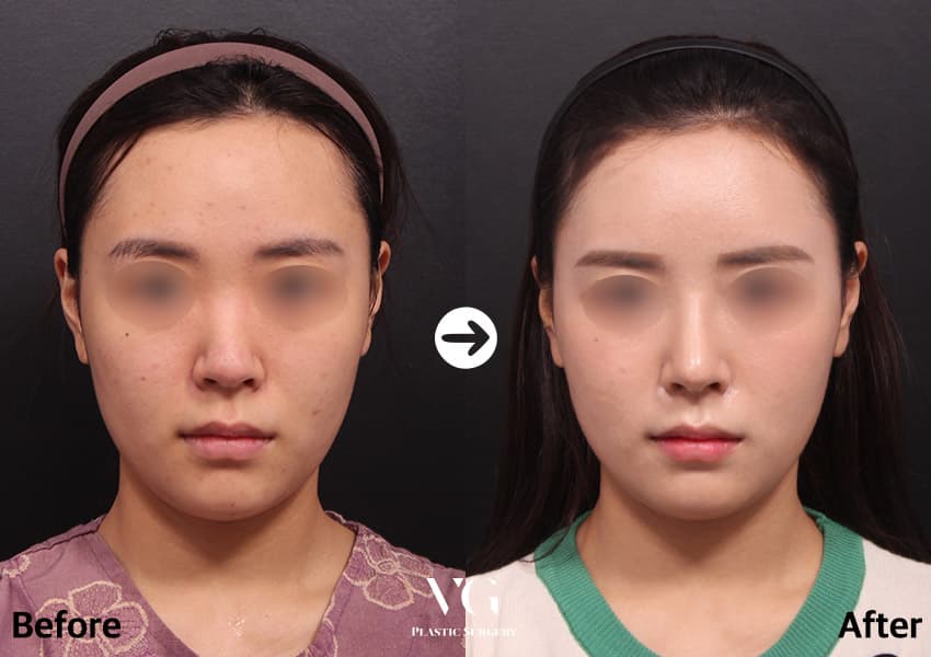 Front view before and after bulbous tip correction: a wide, rounded tip becomes narrower and the bridge line is clearer between the eyes