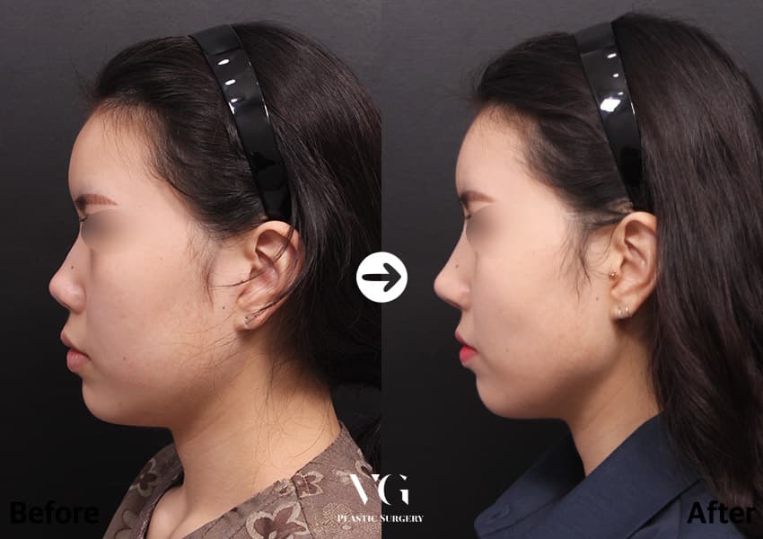 ภาพด้านข้างก่อนและหลังเสริมจมูก 3 เดือน สันจมูกเป็นเส้นตรงขึ้นและปลายจมูกยื่นออกมาพอดี