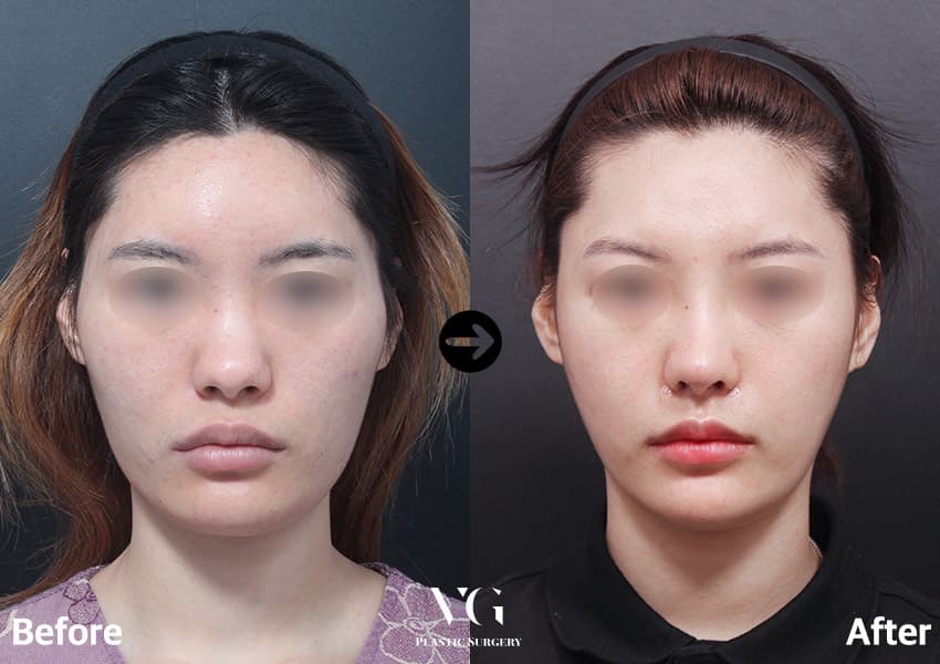 เสริมจมูก + ตกแต่งปลายจมูก + ผ่าตัดกระดูกจมูกให้แคบลง +3