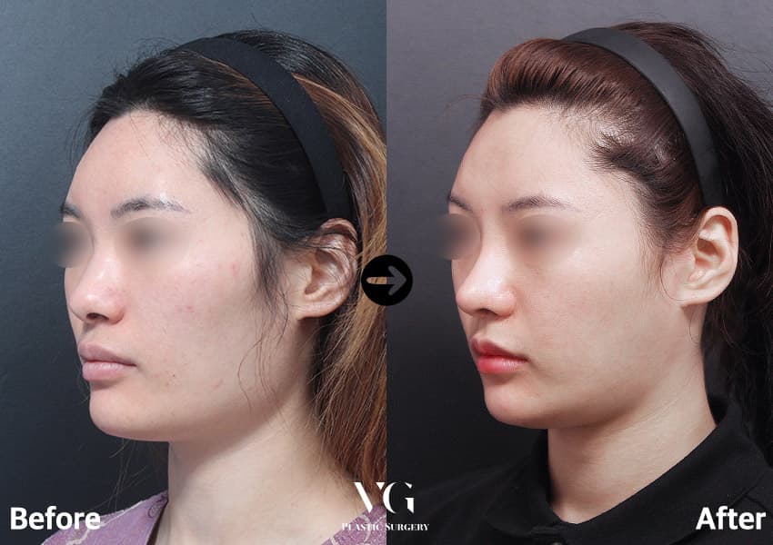 Three-quarter view before and after: the cheekbone no longer bulges sideways and the jaw angle runs in a smoother, longer curve