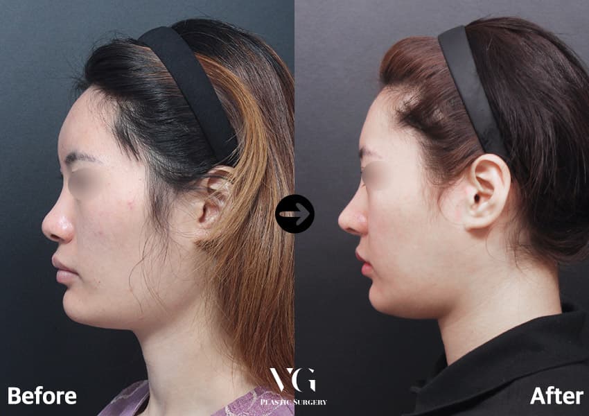 Side profile before and after tip surgery and osteotomy: the nose tip is more defined and the line from bridge to tip is straighter