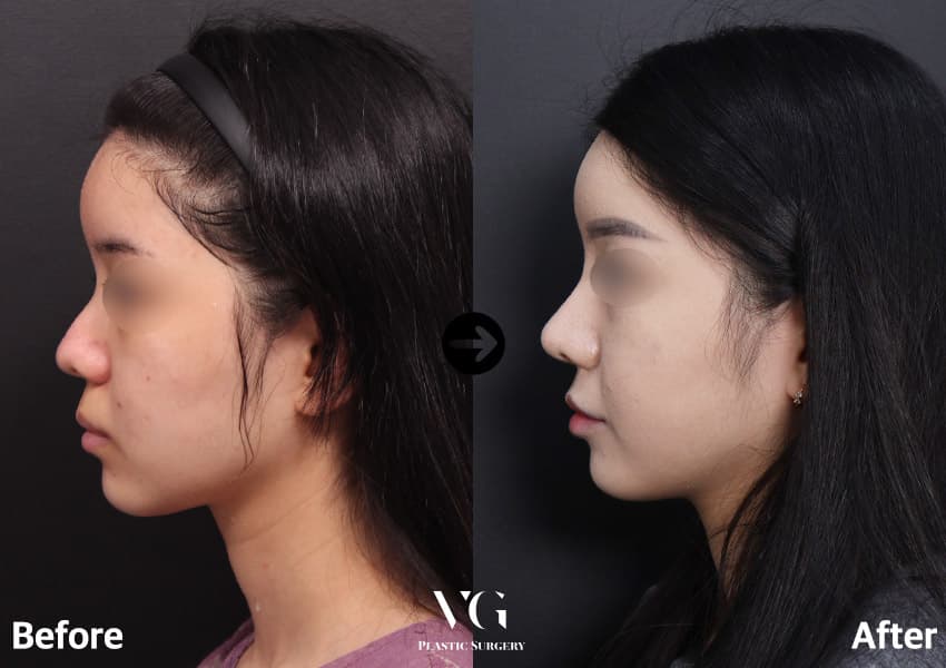 ภาพด้านข้างก่อนและหลังศัลยกรรมจมูกร่วมกับตัดกระดูก 3 เดือน สันจมูกสูงขึ้นและปลายจมูกเล็กลงดูสมดุลกับใบหน้า