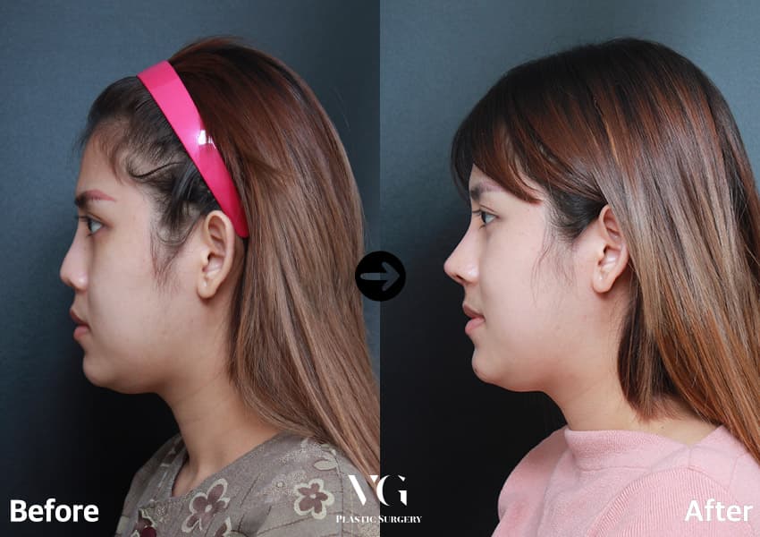 ภาพด้านข้างผู้ป่วยหญิงก่อนและหลังผ่าตัดแก้ไขจมูกด้วยกระดูกอ่อนซี่โครงของตัวเอง 3 เดือน สันจมูกสูงขึ้นและปลายจมูกยื่นขึ้น