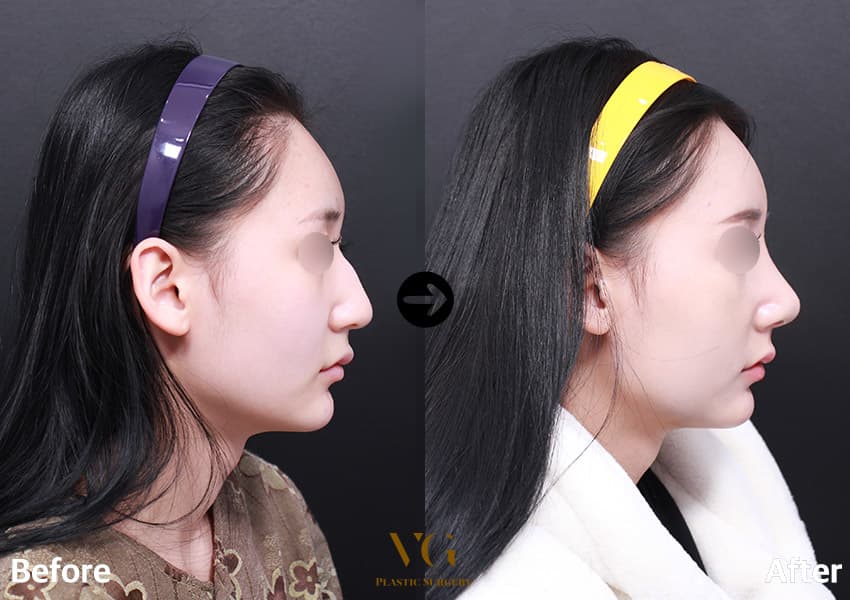 女性の右横顔の術前術後比較。術前は鼻筋の中ほどに段差のある出っ張りがあり、術後は鼻根から鼻先までなだらかな直線になっている