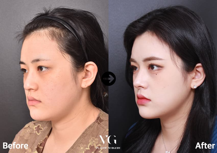 ตาสองชั้นแบบธรรมชาติ + เปิดหางตา + เปิดตาล่าง + ตกแต่งปลายจมูก +1 — มุมที่ 1