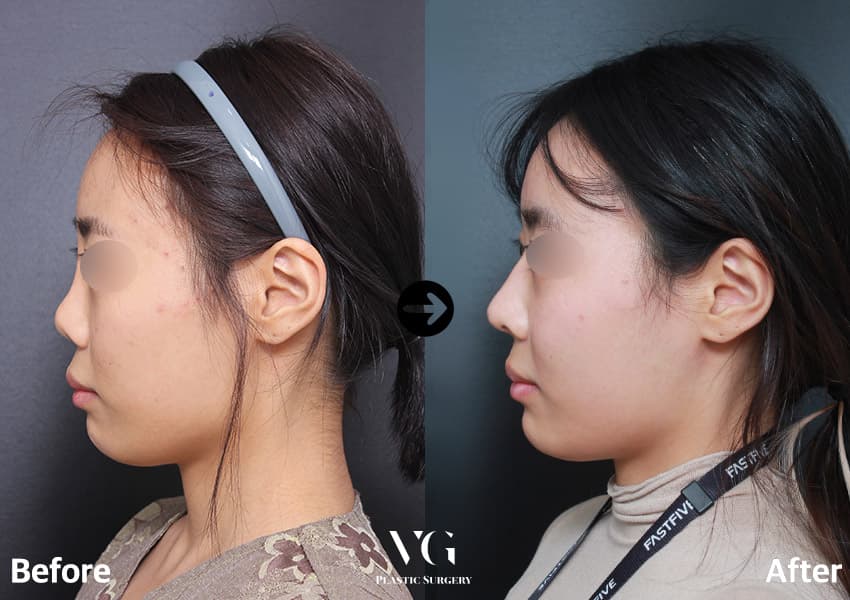 ภาพด้านข้างก่อนและหลังผ่าตัดแก้จมูกด้วยกระดูกอ่อนซี่โครงของตัวเอง 3 เดือน ปลายจมูกยื่นออกมาและสันจมูกต่อเนื่องขึ้น
