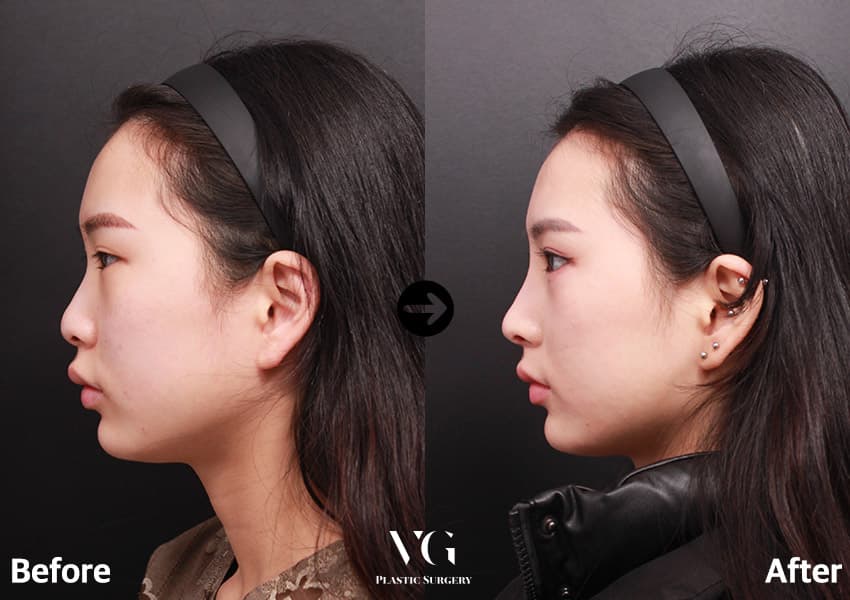 Side profile before and after bridge augmentation: a low bridge between the eyes becomes a raised, straight line running down to the tip