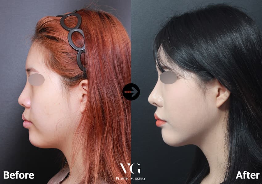 Side profile of the same case before and after: the bridge forms a clear line and the nostril wing looks smaller from the side