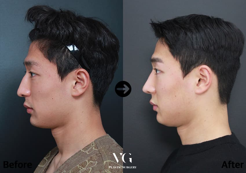 ภาพด้านข้างผู้ชายก่อนและหลังแก้ปลายจมูก แก้โหนกและตัดกระดูกสันจมูก ส่วนโหนกกลางสันหายไปเหลือเส้นตรง