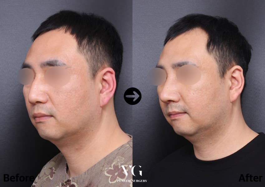 เสริมสันจมูก + แก้ไขจมูกเป็นสัน + ผ่าตัดกระดูกจมูกให้แคบลง +1