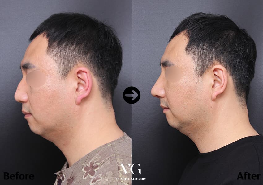 Male side profile before and after bridge augmentation with hump correction and osteotomy using his own rib cartilage: the bump is gone