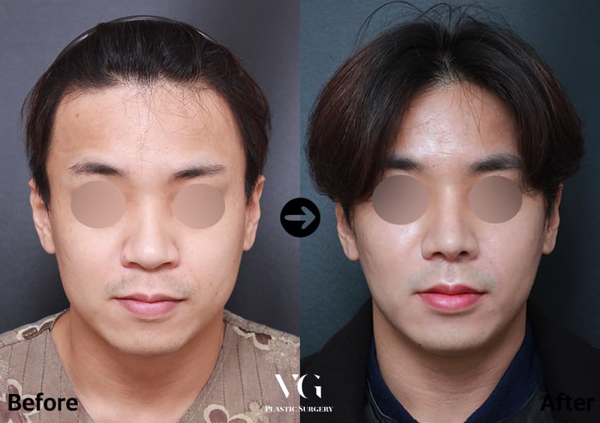 男性鼻部手術合併縮鼻翼的術前術後正面對照:術前鼻翼向兩側張開、鼻子下半部顯寬,術後鼻翼寬度收窄,鼻樑較立體