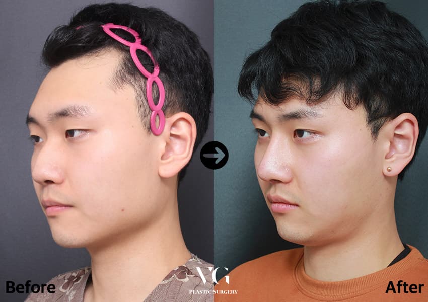 ตาสองชั้นแบบธรรมชาติ + แก้ไขกล้ามเนื้อตาแบบไม่กรีด + เสริมจมูก +1