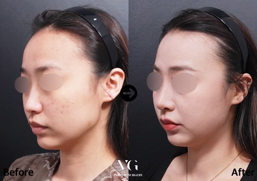 鼻の整形のビフォーアフター — ドラッグして比較