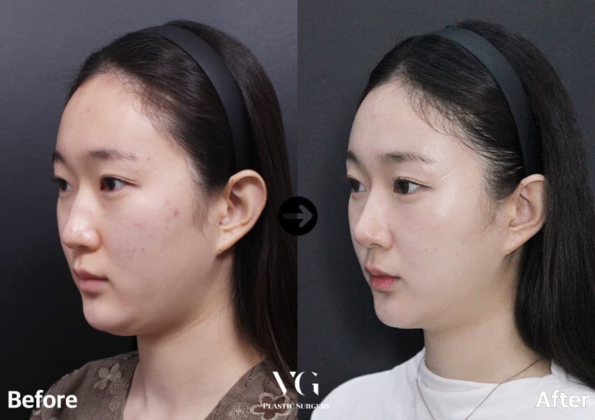 鼻の整形のビフォーアフター — ドラッグして比較