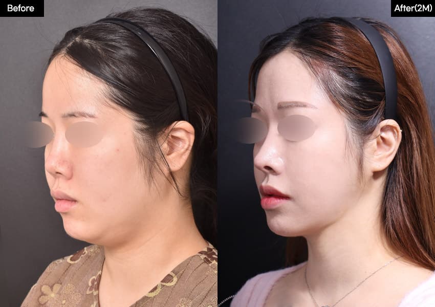 鼻の整形のビフォーアフター — ドラッグして比較