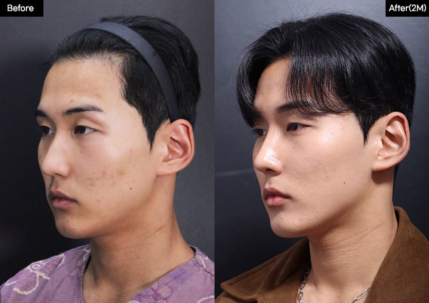 鼻の整形のビフォーアフター — ドラッグして比較