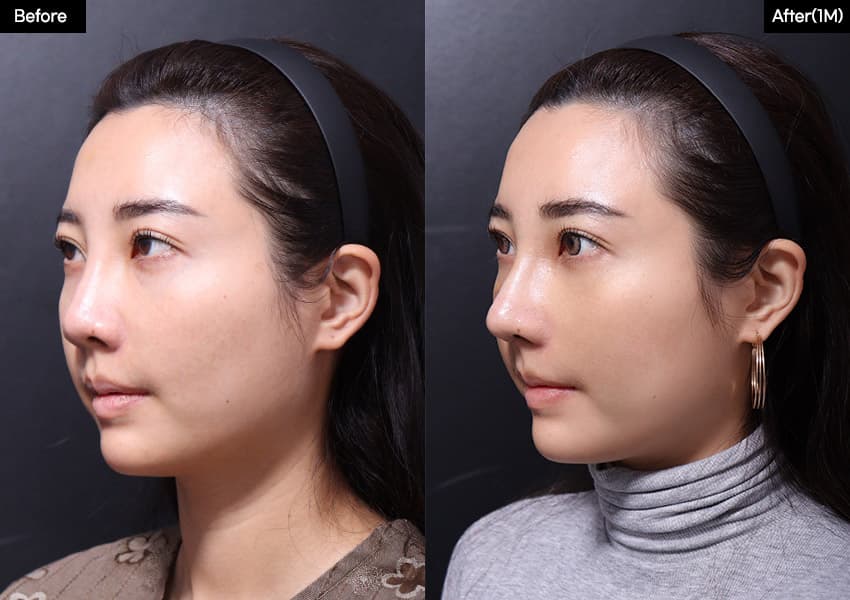 鼻の整形のビフォーアフター — ドラッグして比較