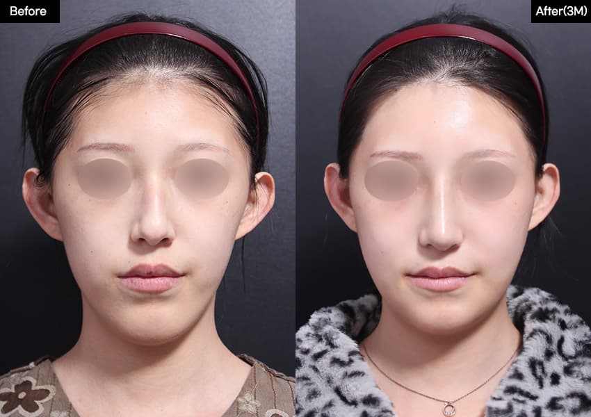 鼻の整形のビフォーアフター — ドラッグして比較