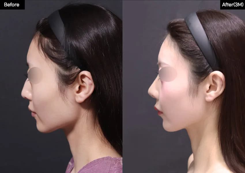 Before and after — Rhinoplasty. Drag the handle to compare.