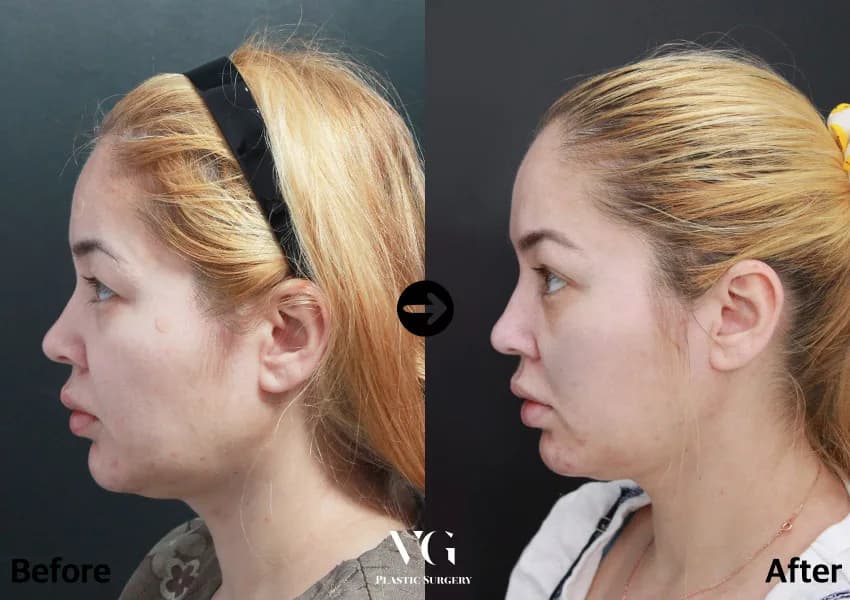 Before and after — Rhinoplasty. Drag the handle to compare.