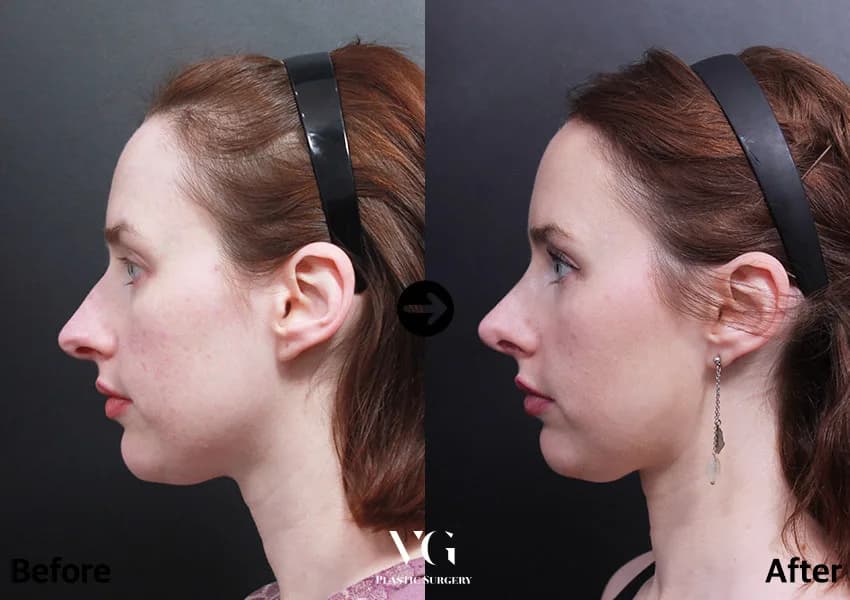 Before and after — Rhinoplasty. Drag the handle to compare.