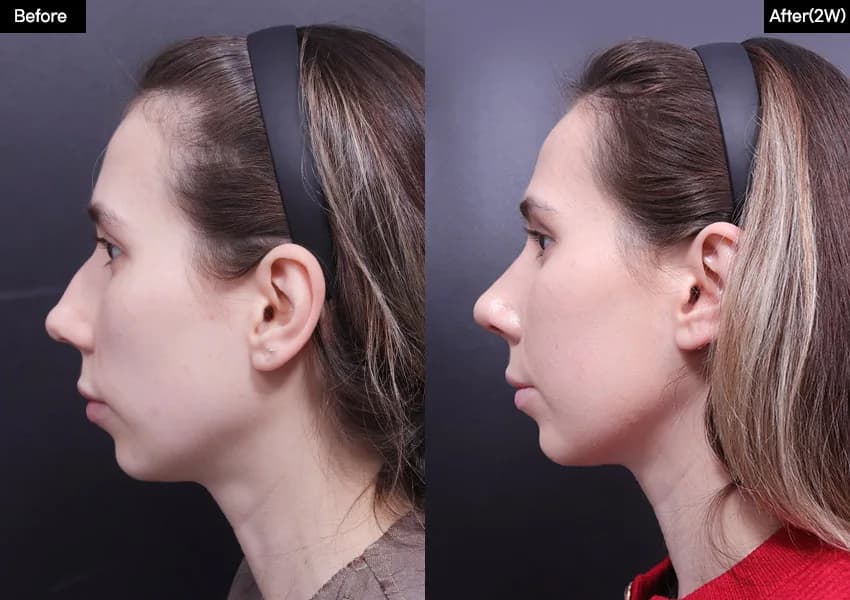 Before and after — Rhinoplasty. Drag the handle to compare.
