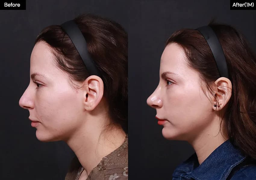 Before and after — Rhinoplasty. Drag the handle to compare.