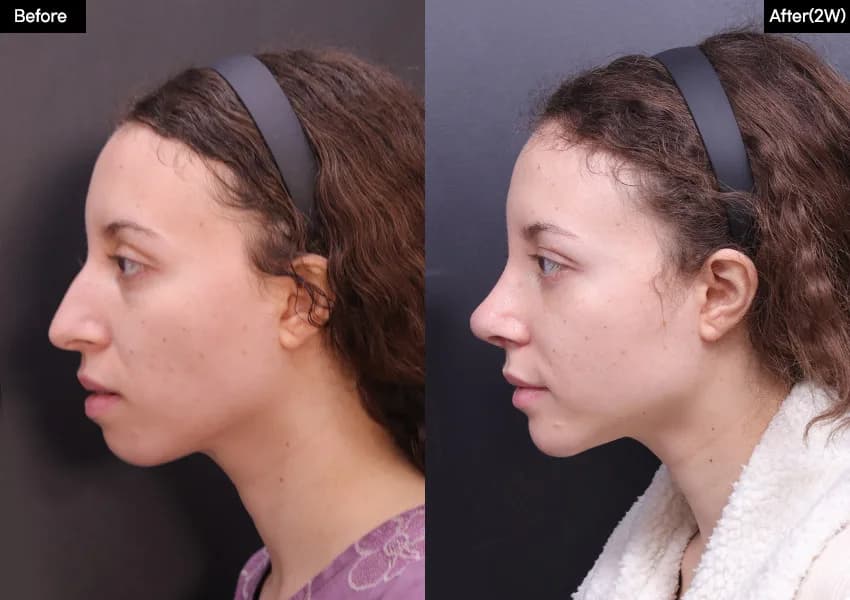 Before and after — Rhinoplasty. Drag the handle to compare.
