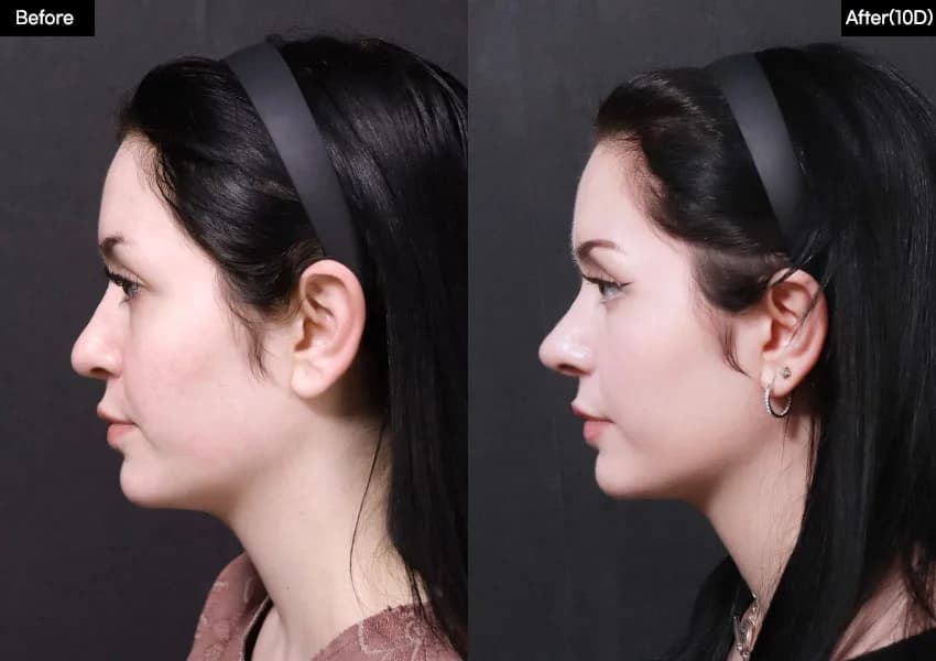 Before and after — Rhinoplasty. Drag the handle to compare.