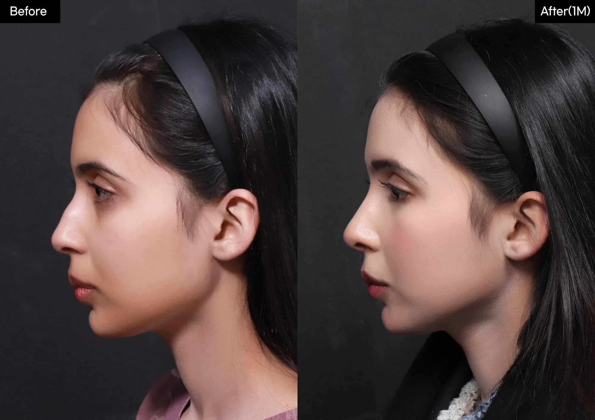 Before and after — Rhinoplasty. Drag the handle to compare.
