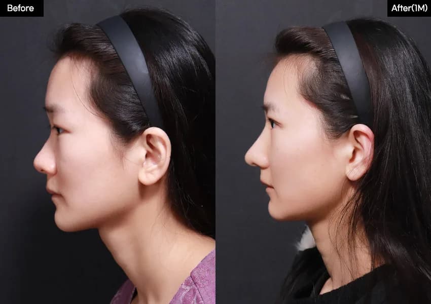 Before and after — Rhinoplasty. Drag the handle to compare.