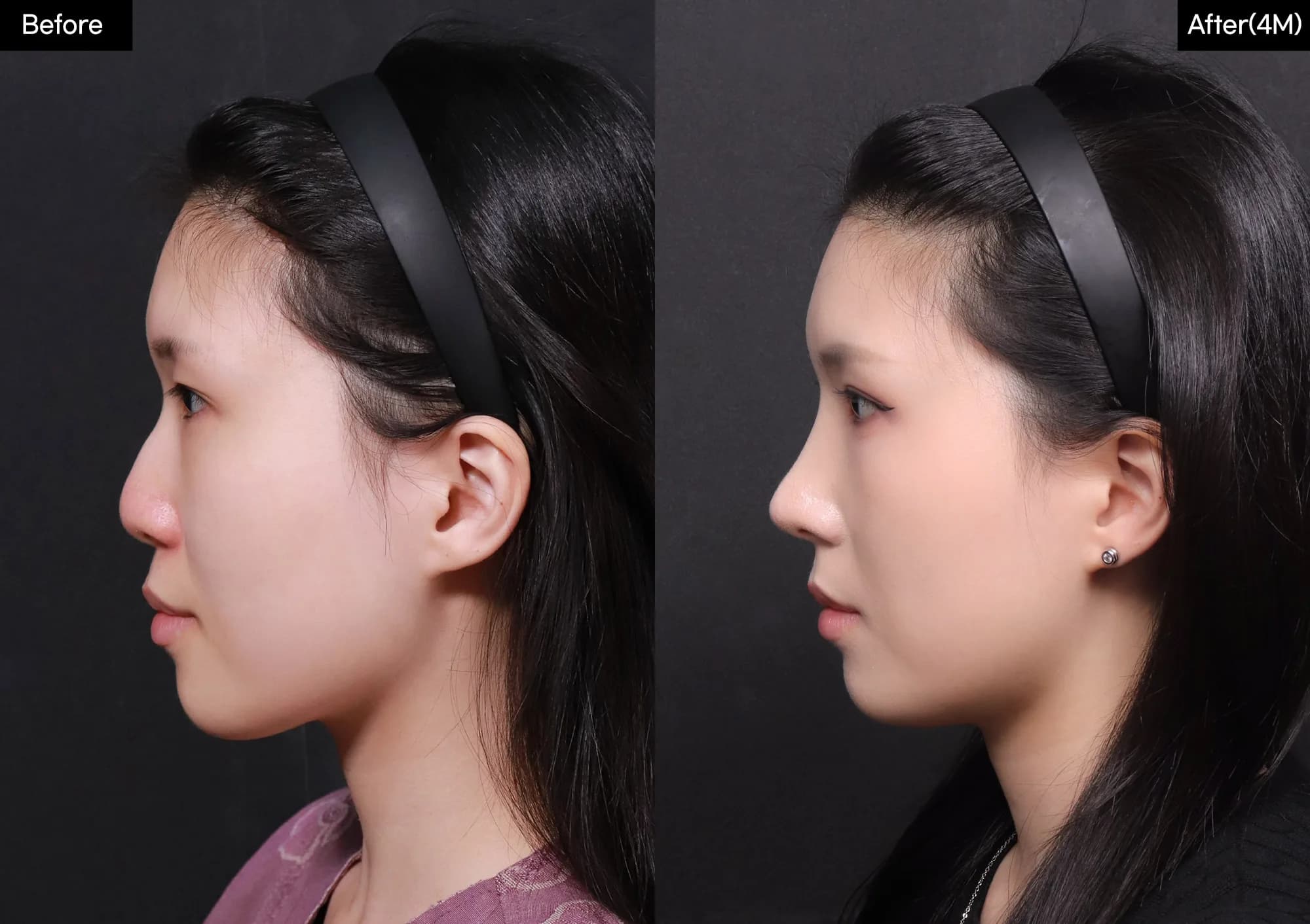 Before and after — Rhinoplasty. Drag the handle to compare.