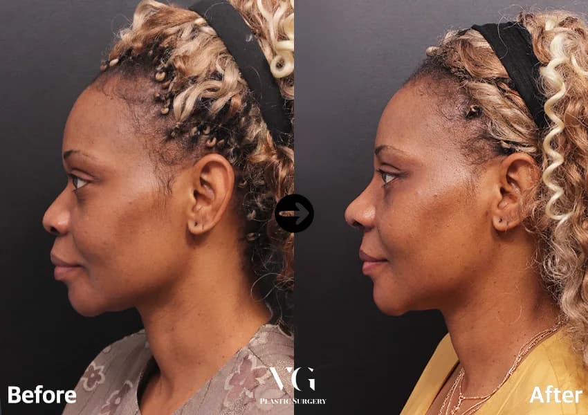 Before and after — Rhinoplasty. Drag the handle to compare.