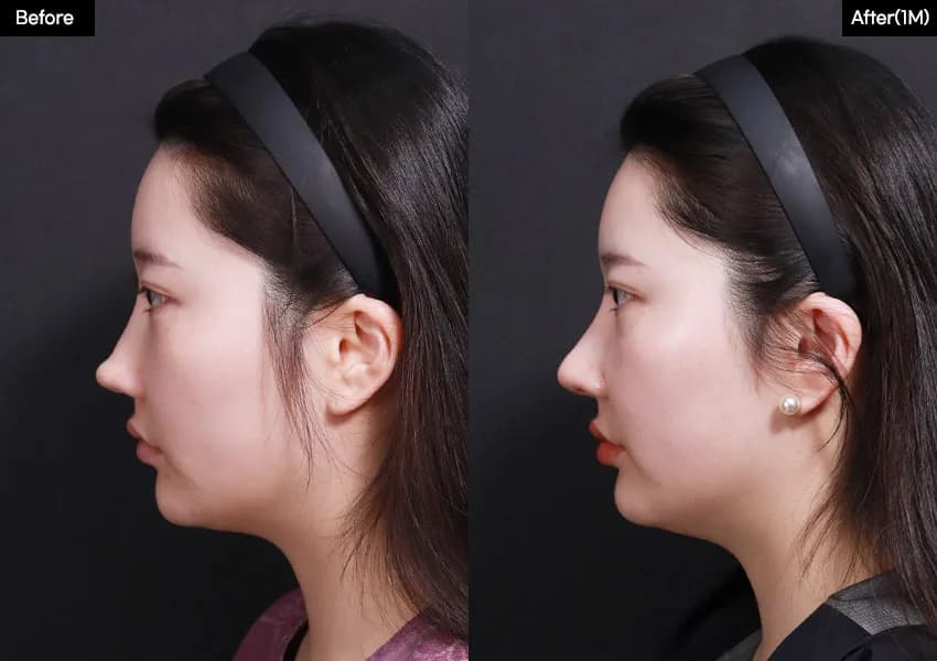 Before and after — Rhinoplasty. Drag the handle to compare.