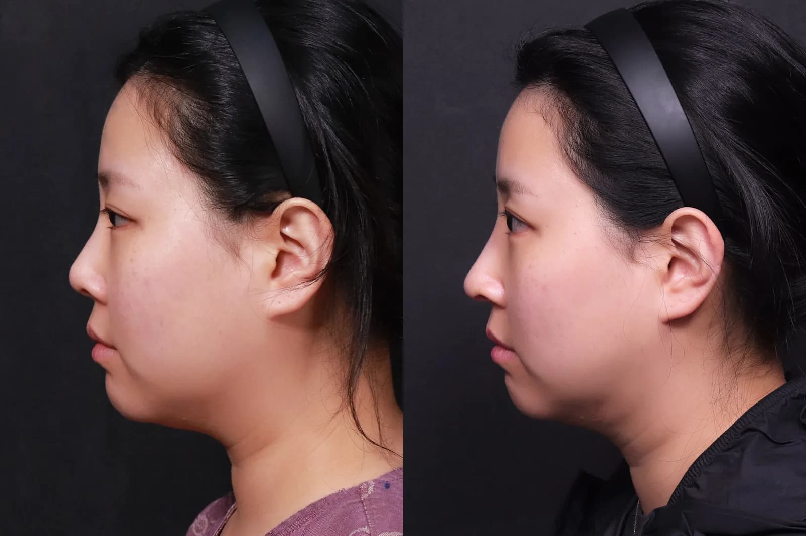 Revision rhinoplasty before and after — before on the left, after on the right