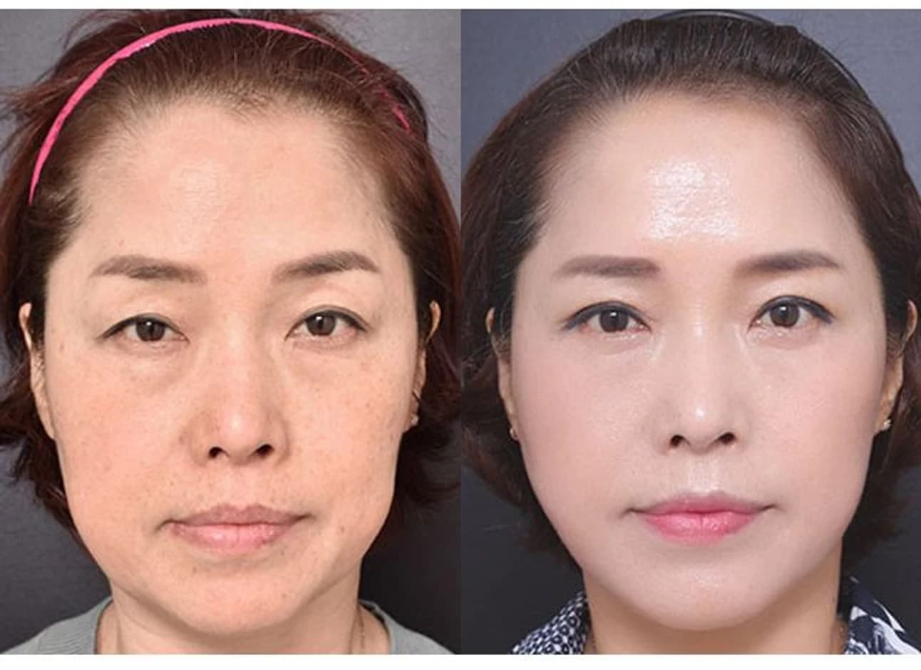 Facelift before and after, front view — four months post-op